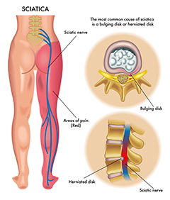 Epidural steroid injection muscle cramps
